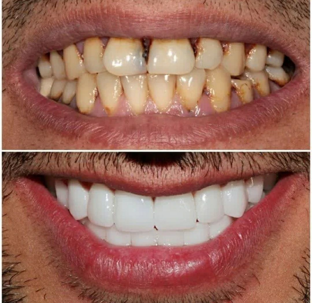 قبل و بعد لمینت دندان سرامیکی در دندانپزشکی آوا شهر قدس-مشاغل ممتاز