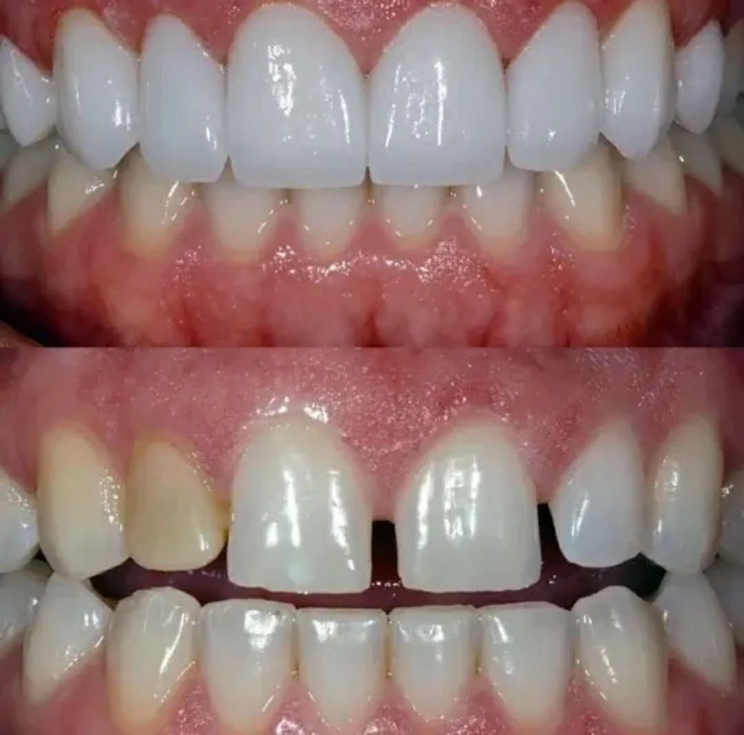 نمونه کار کامپوزیت ونیر و اصلاح طرح لبخند در کلینیک آوا-مشاغل ممتاز