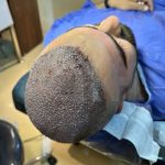 کلینیک کاشت مو رخ در شیراز