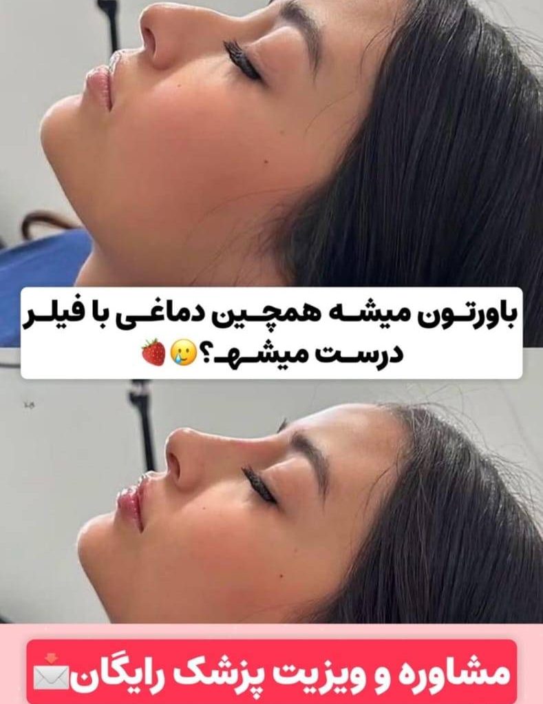 تزریق فیلر دماغ در کلینیک پوست و مو لیلی گوهردشت کرج-مشاغل ممتاز 
