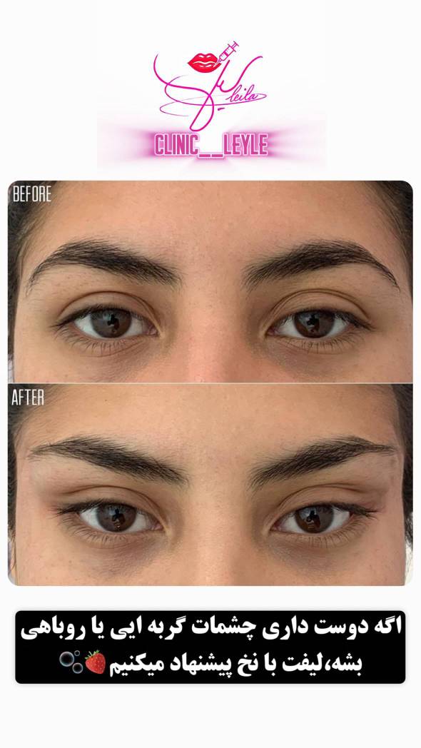 لیفت صورت با نخ کاگ توسط پزشک مجرب در کلینیک زیبایی لیلی گوهردشت-مشاغل ممتاز