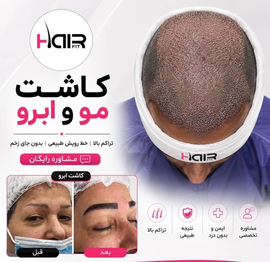 مرکز کاشت مو هیر فیت در اردبیل با تمرکز بر تراکم بالا و ظاهر طبیعی - مشاغل ممتاز
