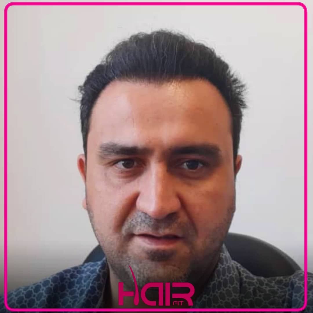 بهترین مرکز کاشت مو و ابرو در اردبیل هیر فیت - مشاغل ممتاز