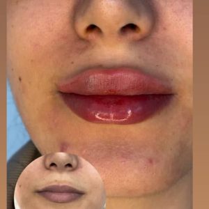 تزریق ژل لب طبیعی و فرم‌دهی حرفه‌ای در کلینیک زیبایی الیزه سناباد مشهد -مشاغل ممتاز