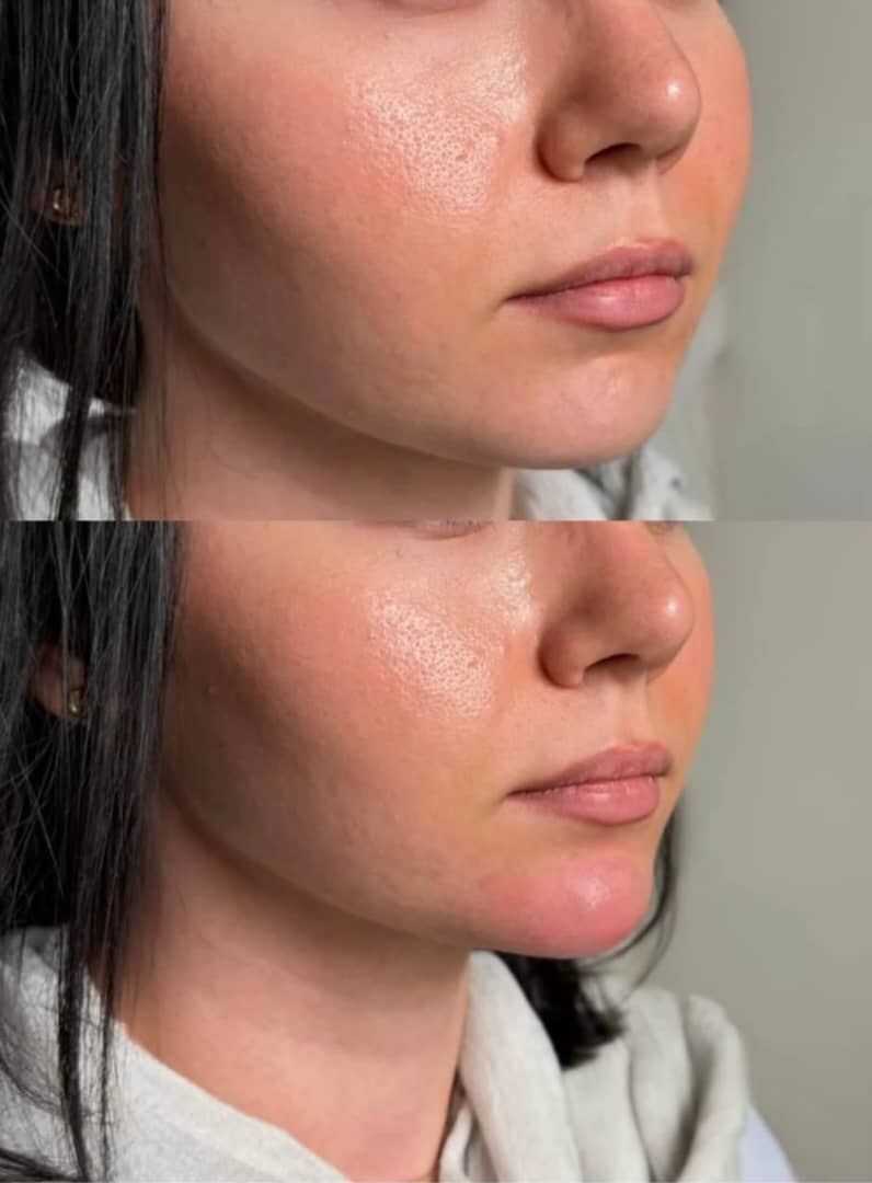 قبل و بعد تزریق ژل چانه در کلینیک زیبایی الیزه، واقع در سناباد مشهد -مشاغل ممتاز