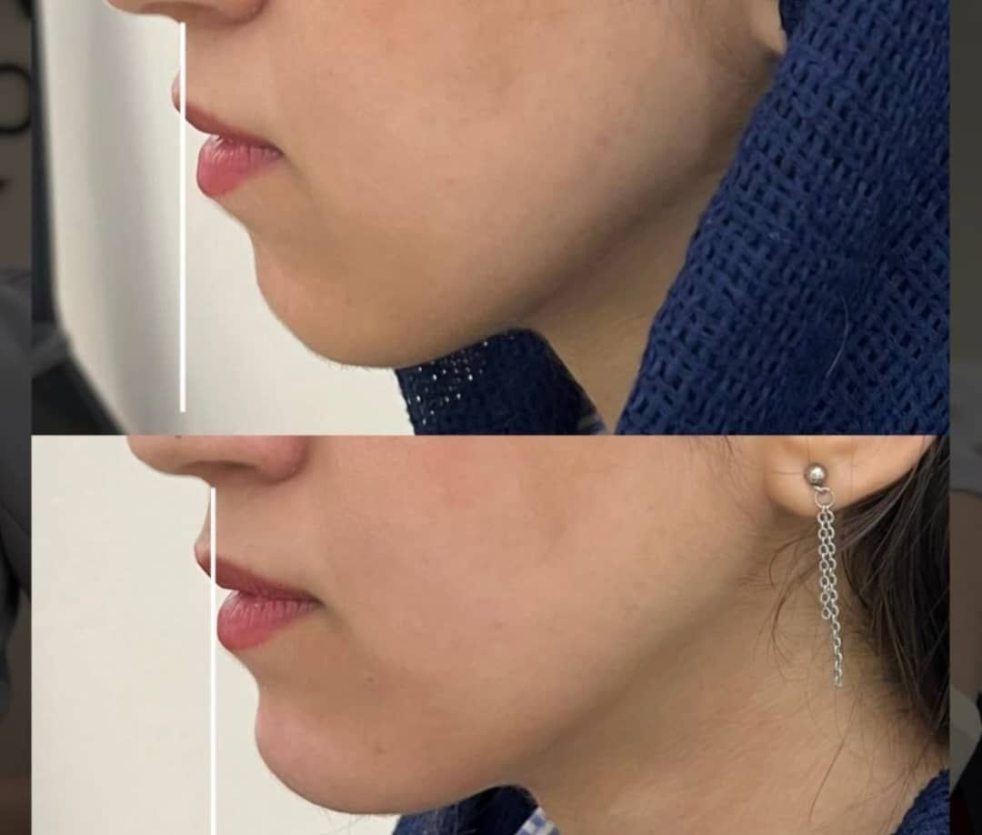 زاویه فک در کلینیک زیبایی الیزه سناباد مشهد -مشاغل ممتاز