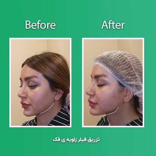 نمونه کار لیفت و جوانسازی پوست در مطب زیبایی آتی بیوتی در کرج -مشاغل ممتاز