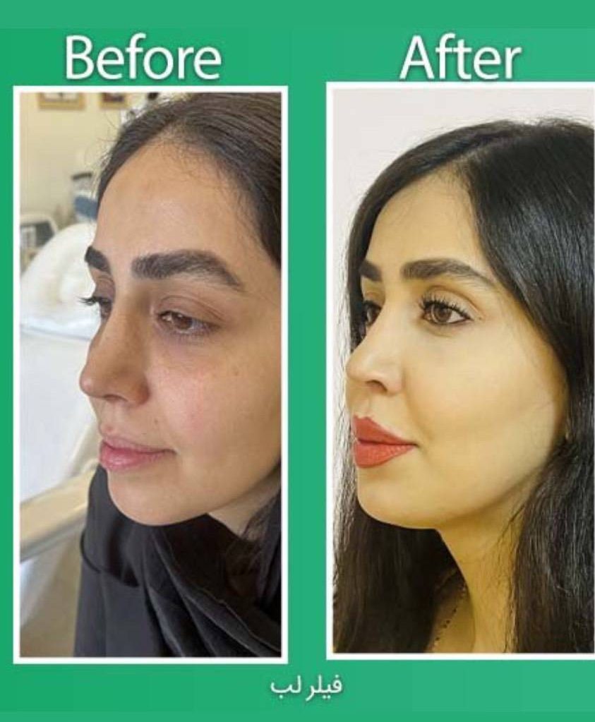 جوانسازی صورت با هایفو ۷ بعدی کره‌ای در کلینیک آتی بیوتی -مشاغل ممتاز