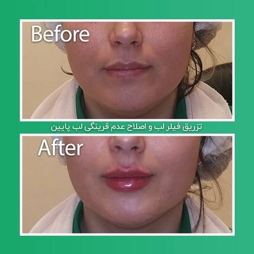  تزریق ژل لب در مطب زیبایی آتی بیوتی در کرج -مشاغل ممتاز
