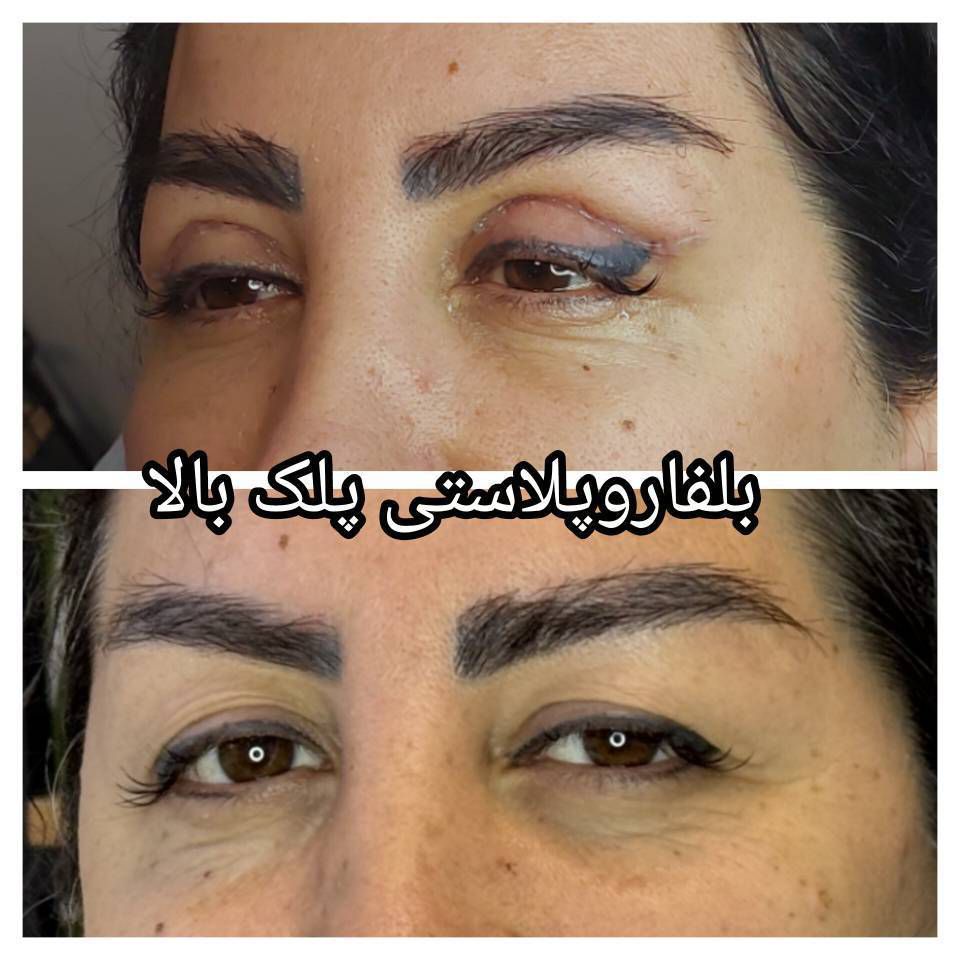 بلفاروپلاستی تخصصی در کلینیک زیبایی و لاغری حمیدی رشت_مشاغل ممتاز