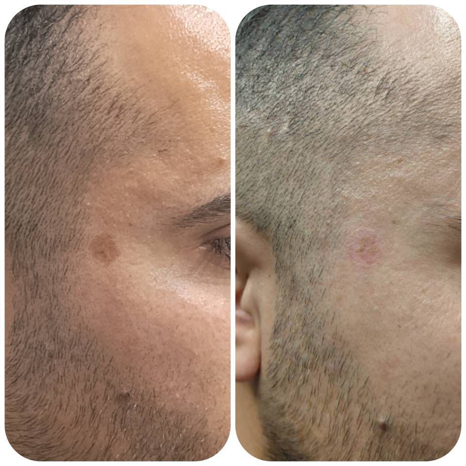 برداشت خال و ضایعات پوستی در کلینیک زیبایی و لاغری حمیدی رشت_مشاغل ممتاز