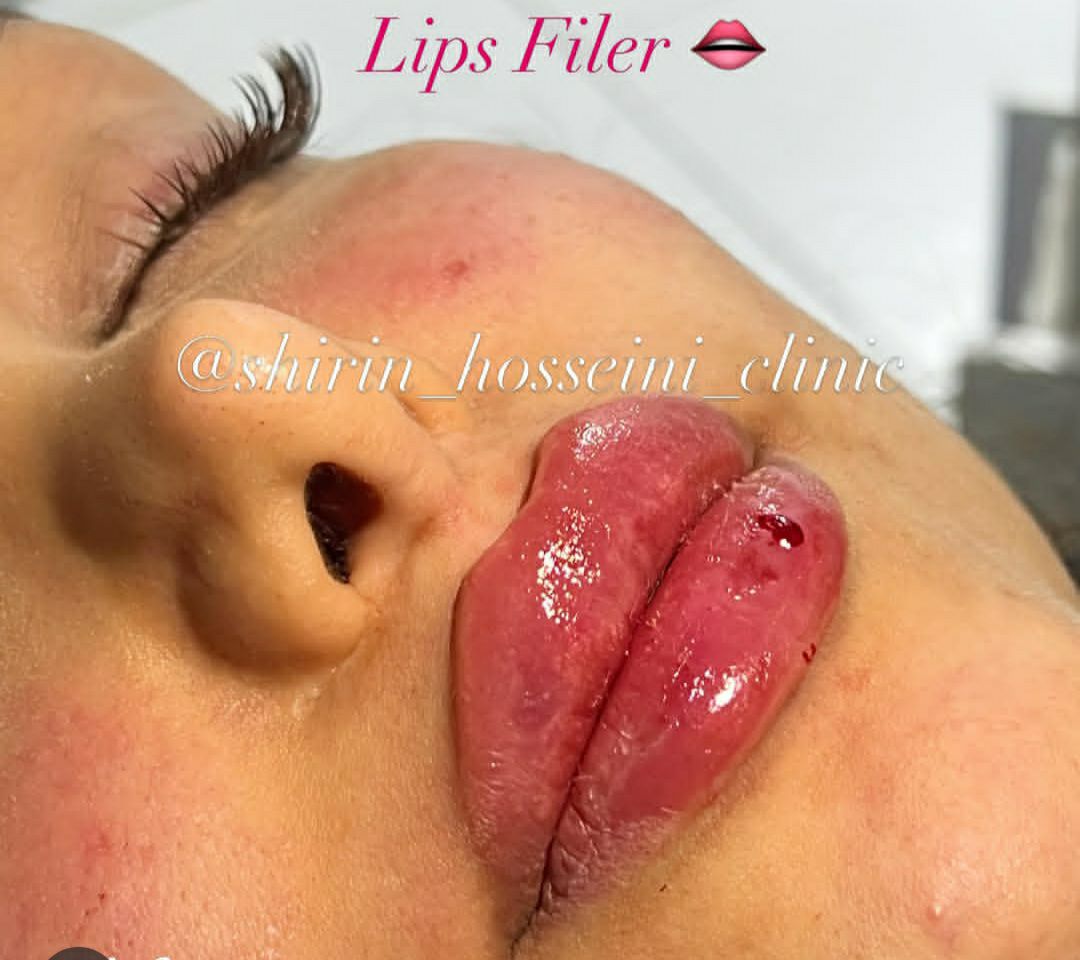 تزریق ژل لب در کلینیک زیبایی شیرین حسینی اهواز - مشاغل ممتاز