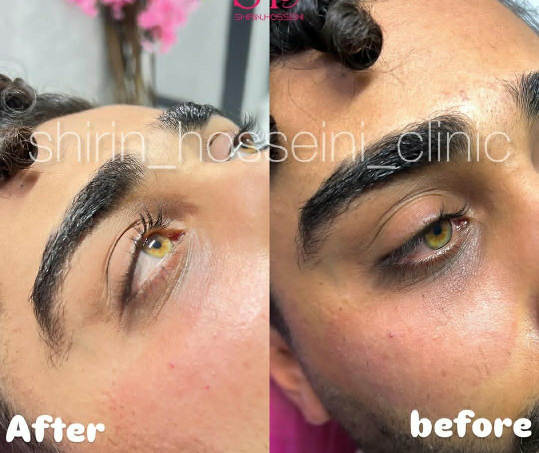 مقایسه قبل و بعد تزریق ژل و فیلر چشم شیرین حسینی اهواز - مشاغل ممتاز