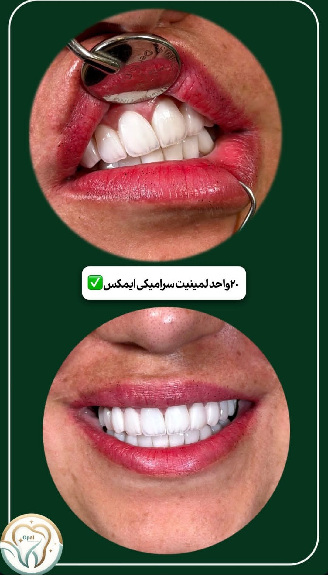 لبخند زیبا و طبیعی بیمار پس از درمان در کلینیک دندانپزشکی دیجیتال اپال کرمان