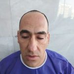 مرکز کاشت مو و ابرو شریف زاده در اصفهان