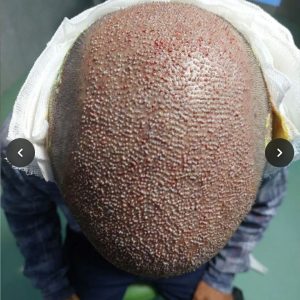 مرکز کاشت مو و ابرو شریف زاده در اصفهان با خدمات تخصصی و طبیعی -مشاغل ممتاز