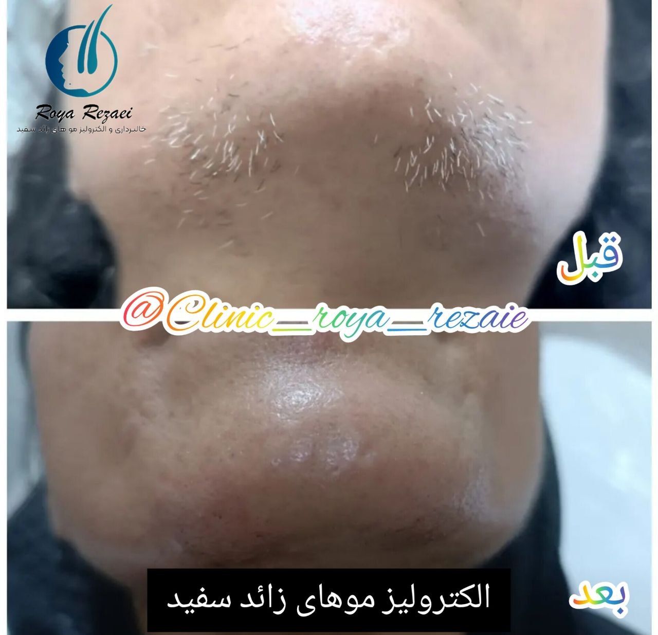 خدمات حرفه‌ای الکترولیز در مرکز تخصصی رویا رضایی ارومیه-مشاغل ممتاز