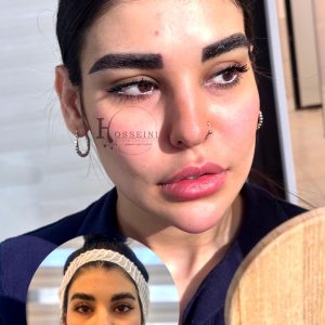 نتیجه کاشت ابرو طبیعی و با تراکم بالا در کلینیک بهاره حسینی اهواز-مشاغل ممتاز