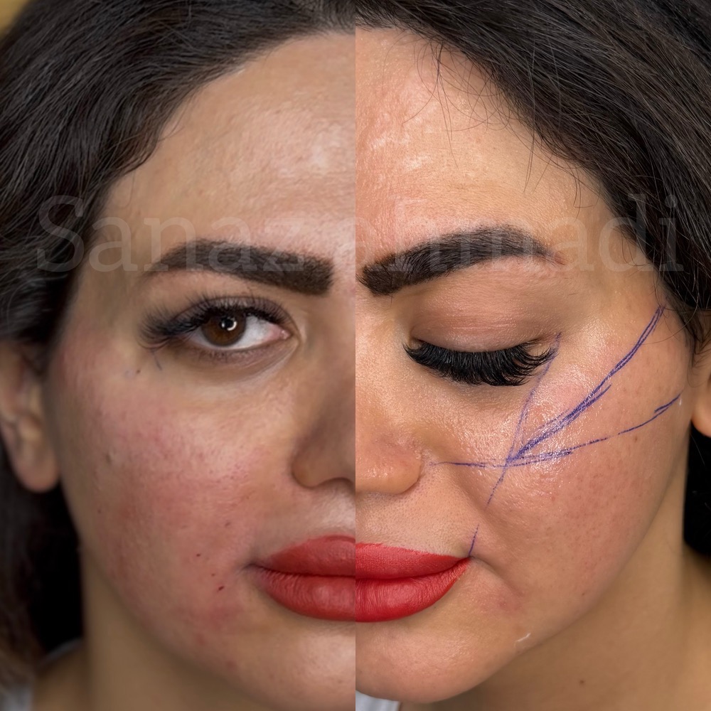 لیفت با نخ در مرکز زیبایی ابرا پرند - مشاغل ممتاز