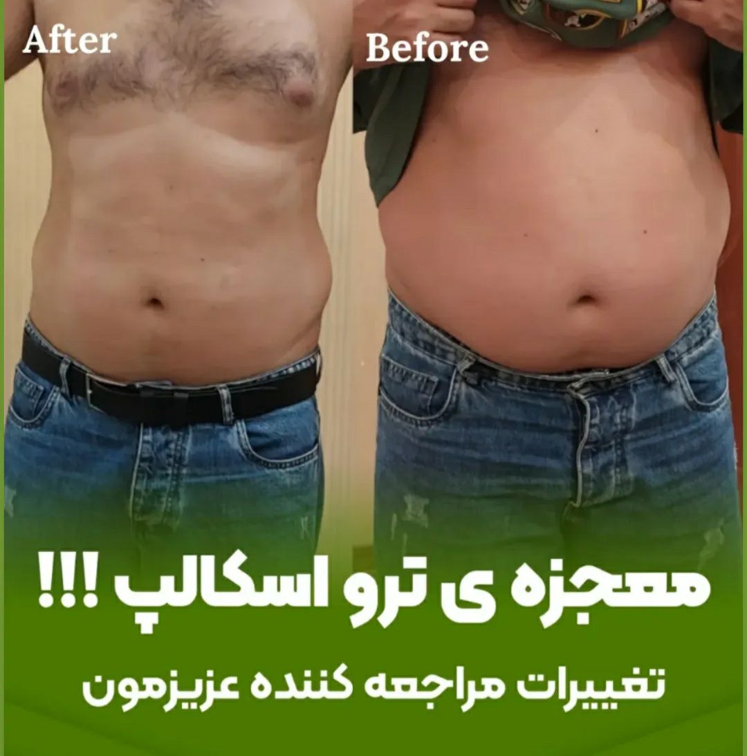 کاهش چربیهای موضعی بدون جراحی با ترو اسکالپ شیراز-مشاغل ممتاز