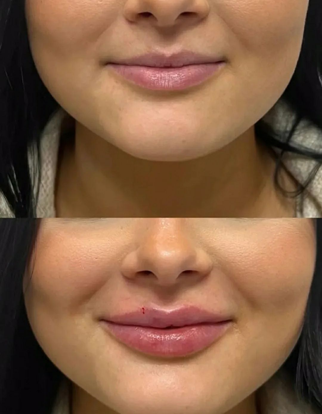 تزریق تخصصی فیلر لب و اصلاح فرم چهره در مرکز زیبایی مهسا زمرد شیراز -مشاغل ممتاز