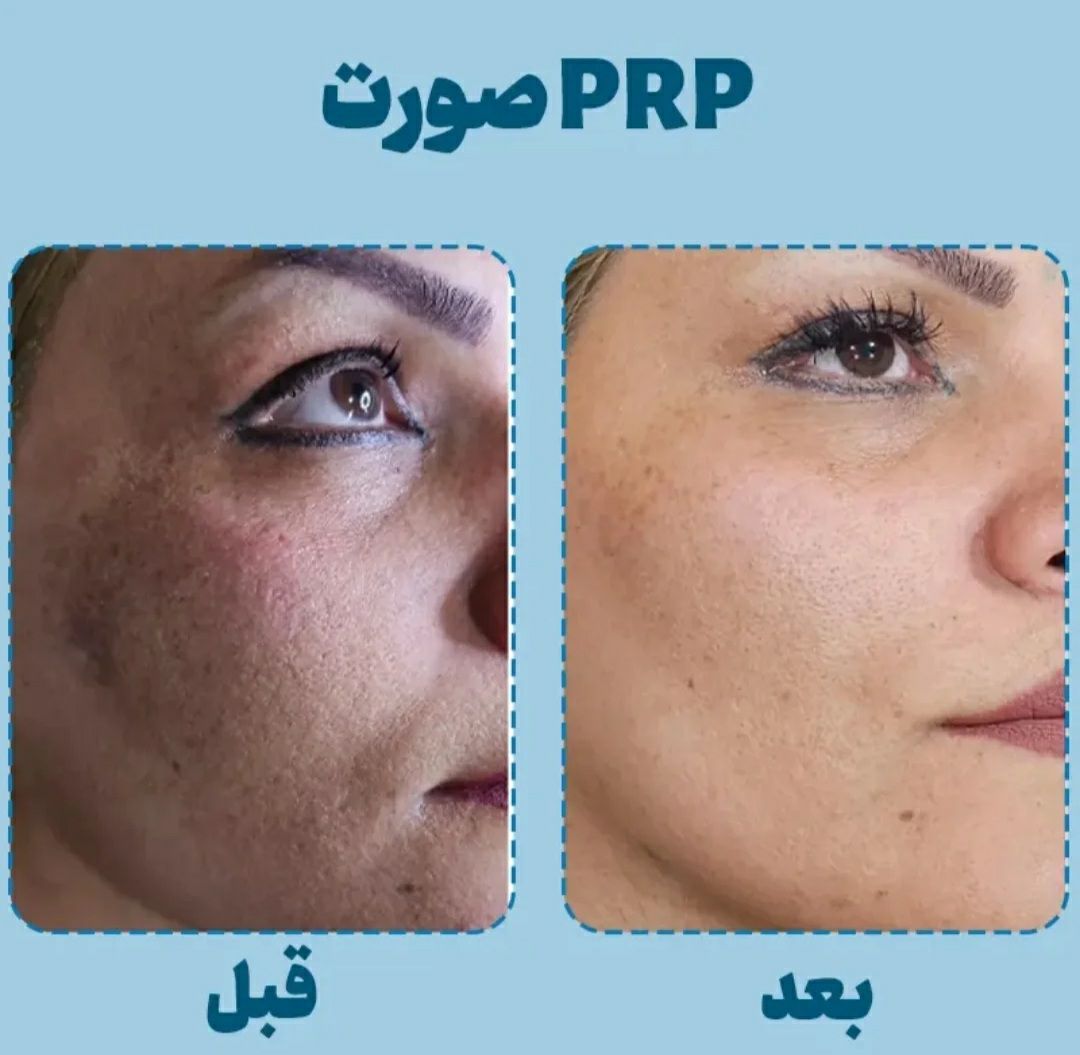 جوانسازی و کلاژنسازی پوست صورت با روش پیآرپی (PRP) در شیراز -مشاغل ممتاز