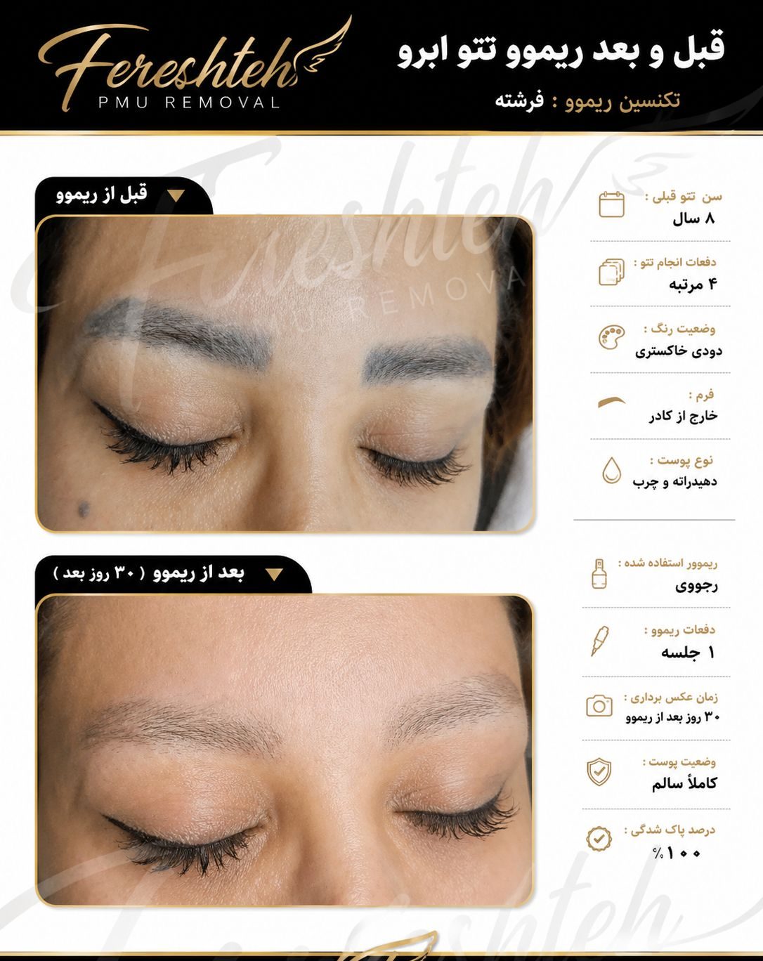 ریموو تتو ابرو خط چشم فرشته در خرم آباد به صورت تخصصی-مشاغل ممتاز