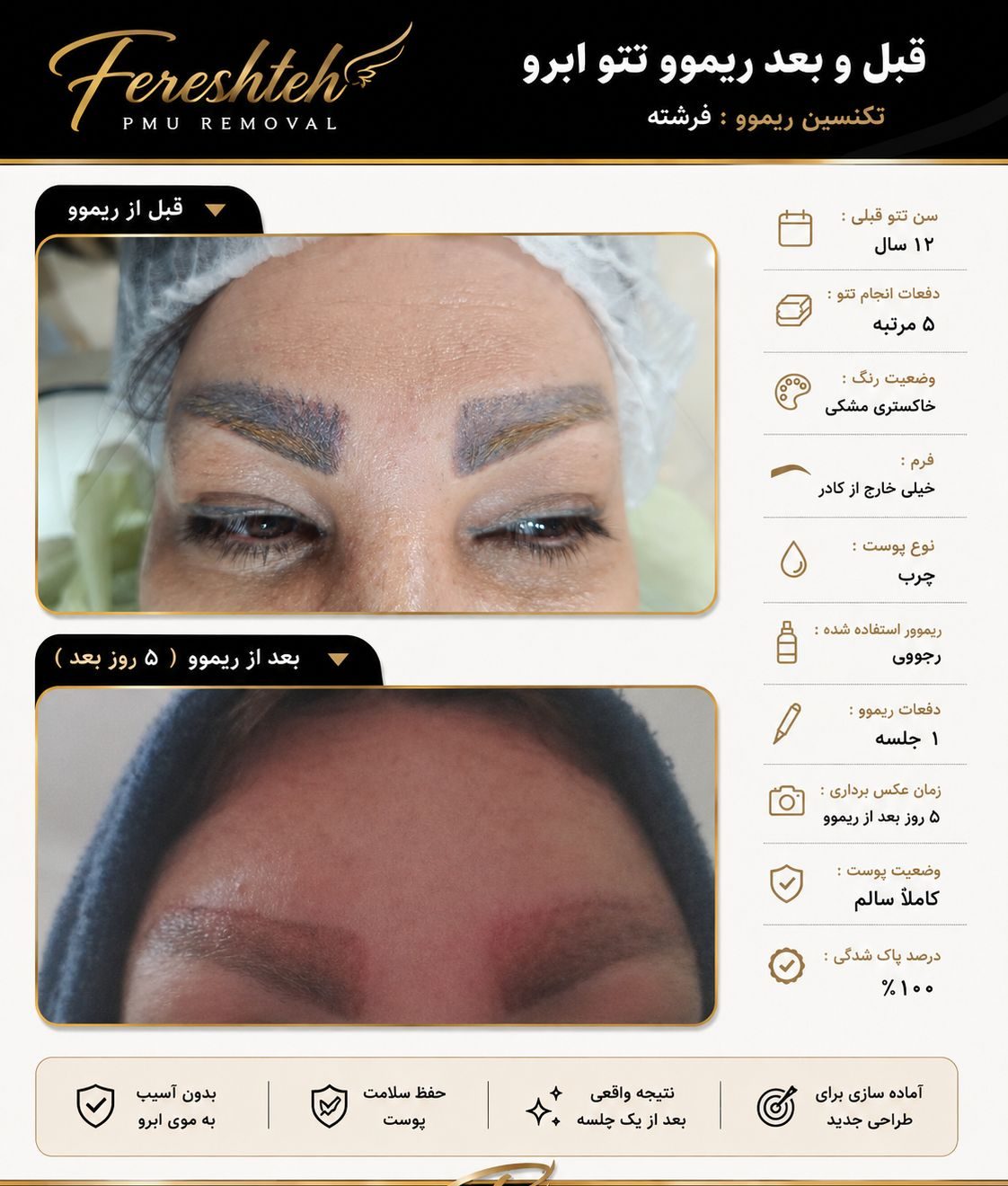 پاک کردن تخصصی تاتو ابرو خط چشم و خط لب در خرم آباد