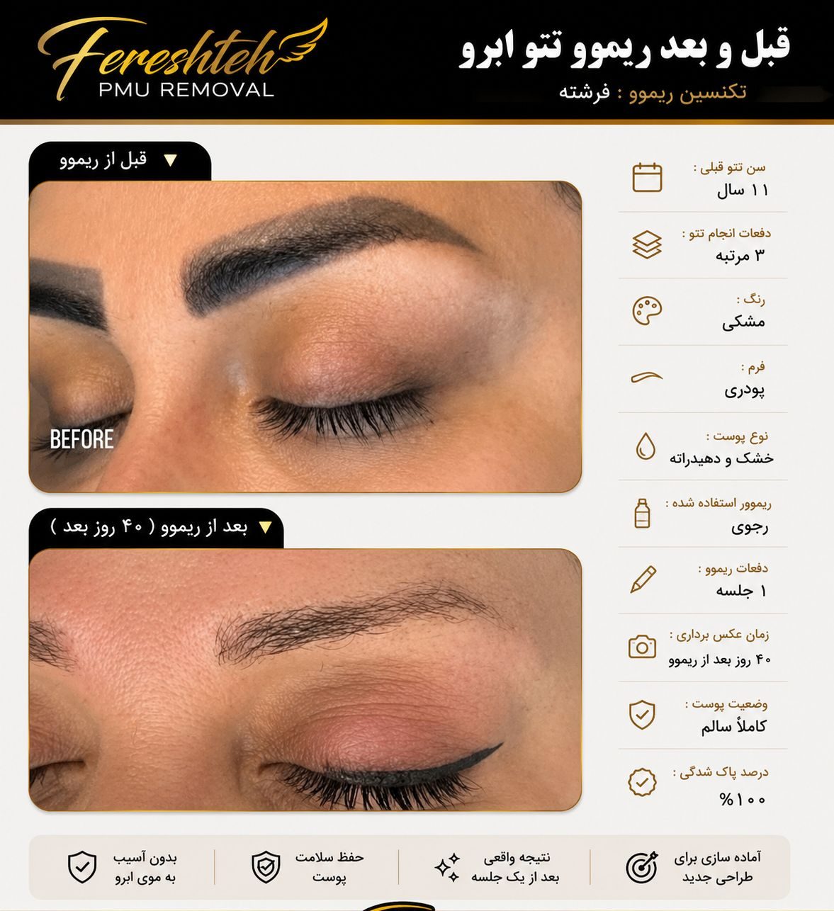 ریموو حرفهای تتو ابرو و خط چشم فرشته با دقت بالا