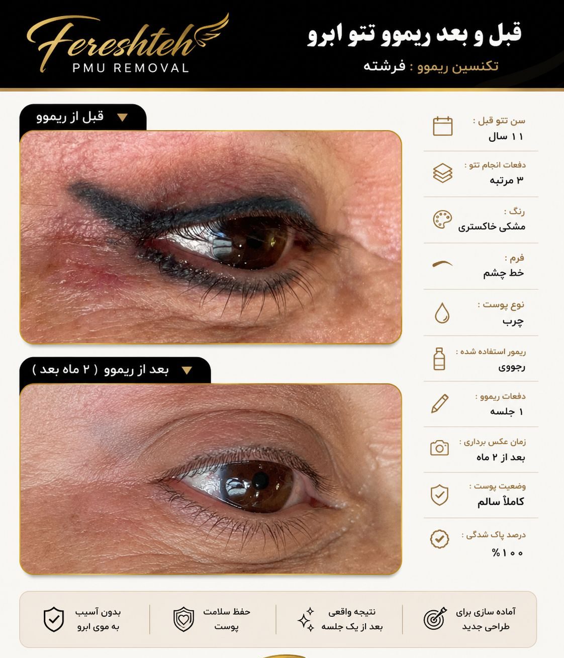 پاک کردن تخصصی تاتو خط چشم در خرم آباد-مشاغل ممتاز