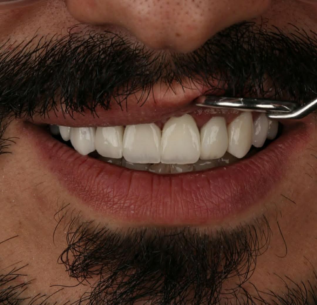 جرمگیری و بروساژ دندان در کلینیک دندانپزشکی گلفام در شیراز
