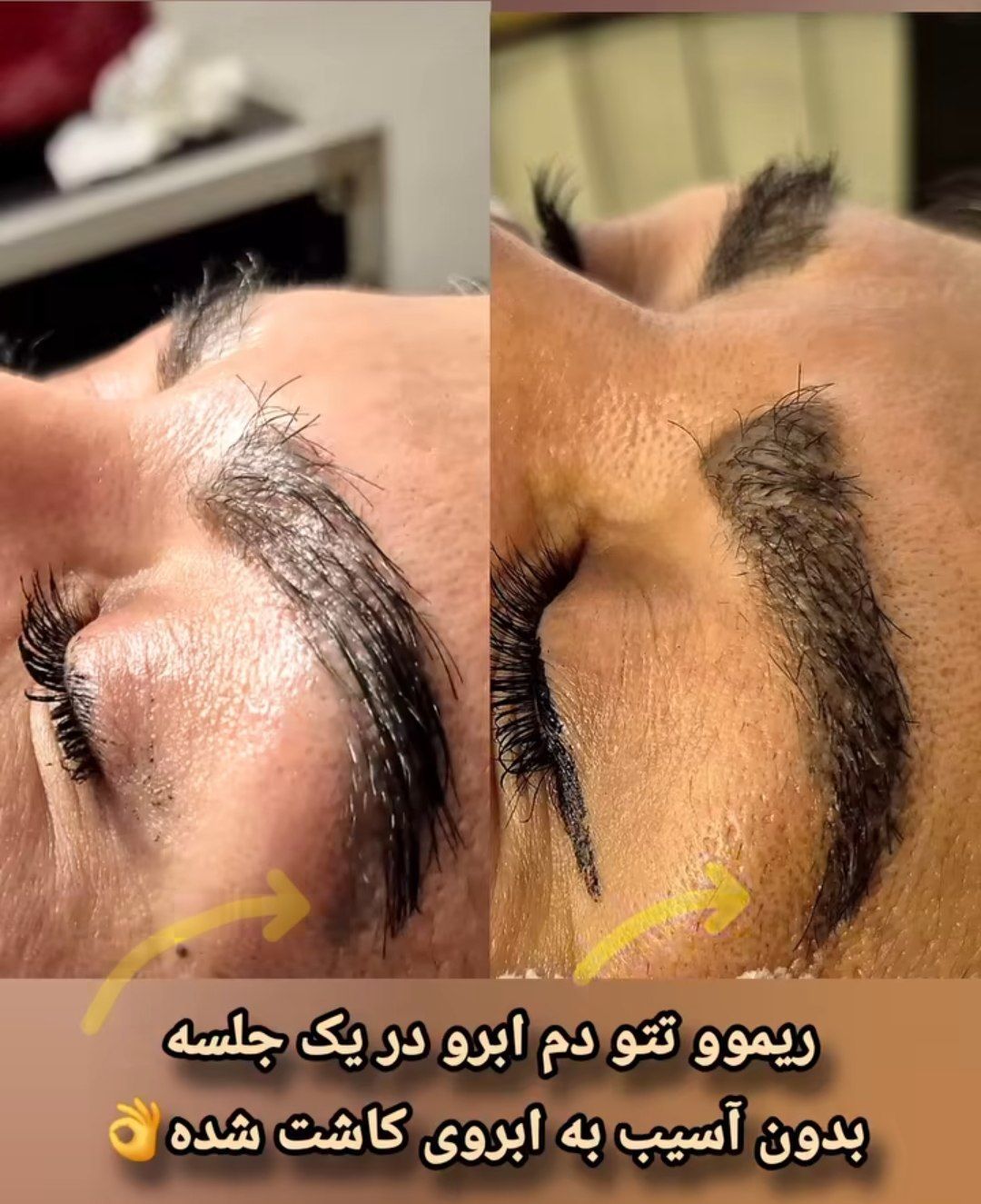 لیزر ریموو تتو پیکوشور مریم شکری در کرج-مشاغل ممتاز