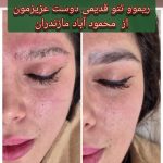 لیزر ریموو تتو پیکوشور مریم شکری در کرج