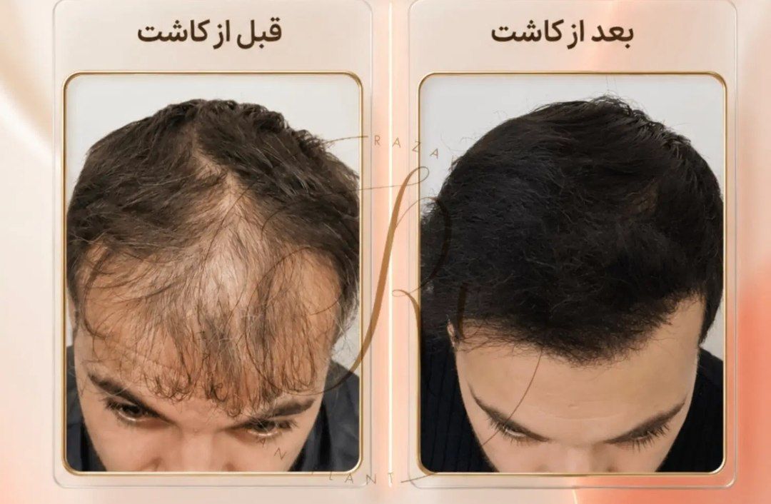 نتیجه نهایی کاشت موی طبیعی و پرتراکم به روش شیرازی در کلینیک رضوی