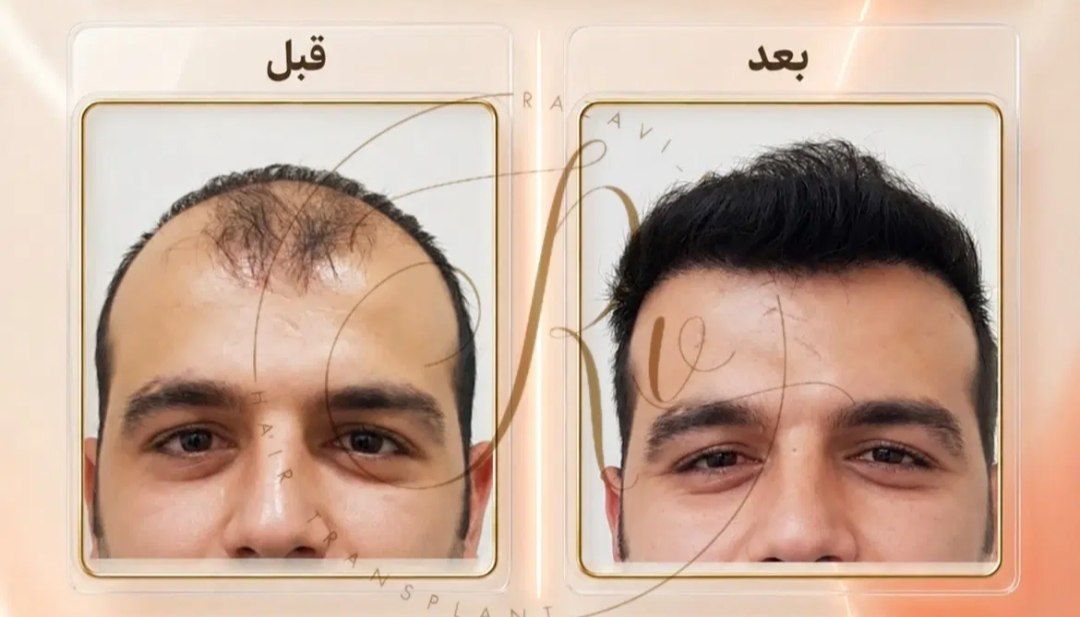 استفاده از دستگاههای کرهای پیشرفته در فرآیند استخراج گرافتهای مو