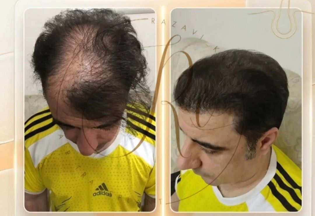 کاشت مو رضوی در قم_مشاغل ممتاز