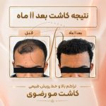 کاشت مو رضوی در قم