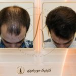 کاشت مو رضوی در قم