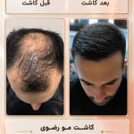 کاشت مو رضوی در قم