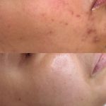 آموزش خدمات فیشال پوست مونا واسع زاده در پیروزی تهران