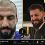 کاشت مو و ابرو محیا شهیدی در شیراز