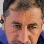 کاشت مو و ابرو محیا شهیدی در شیراز